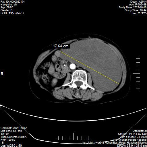 CT檢查影像中黃色線提示腫瘤最長徑.jpg